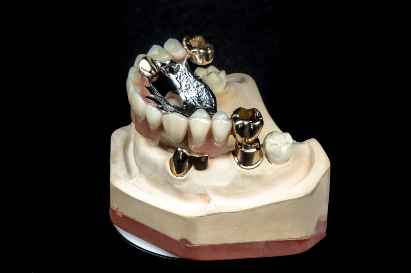 R&V Qualitätszahntechnik - Dentallabor - ein gegossenes Metallgerüst für eine herausnehmbare Teilprothese,
