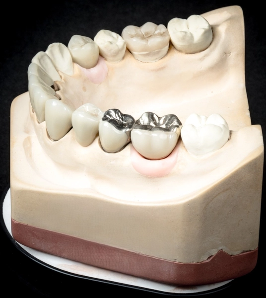 R&V Qualitätszahntechnik - Dentallabor - ein gegossenes Metallgerüst für eine herausnehmbare Teilprothese,