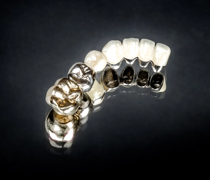 R&V Qualitätszahntechnik - Dentallabor - ein gegossenes Metallgerüst für eine herausnehmbare Teilprothese,